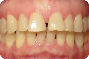 Arcadad dentária com diastema
