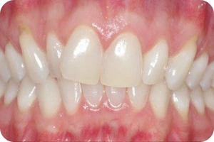 Arcada dentária com dentes irregulares