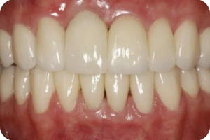 imagem de uma arcada dentária mostrando dentes brancos