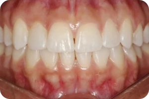 Arcada dentária alinhada com invisalign