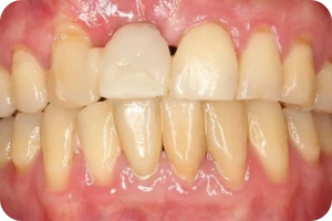 arcada dentária com um dente danificado