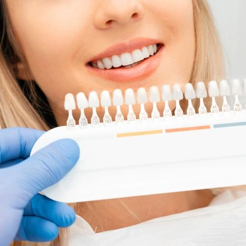 uma paleta de cores de dentes colocada a frente do sorriso de uma moça para a comparação e escolha de cores das lentes para clareamento dental